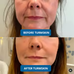 💥Buy more&Save more💥3% Hyaluronic Acid Ultra Hydrating Serum by TurmSkin