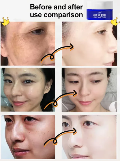 🔥BUY 1 GET 1 FREE 🔥 Spot Fading Urea Cream